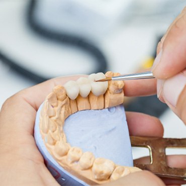 a model of a mouth with a bridge on it